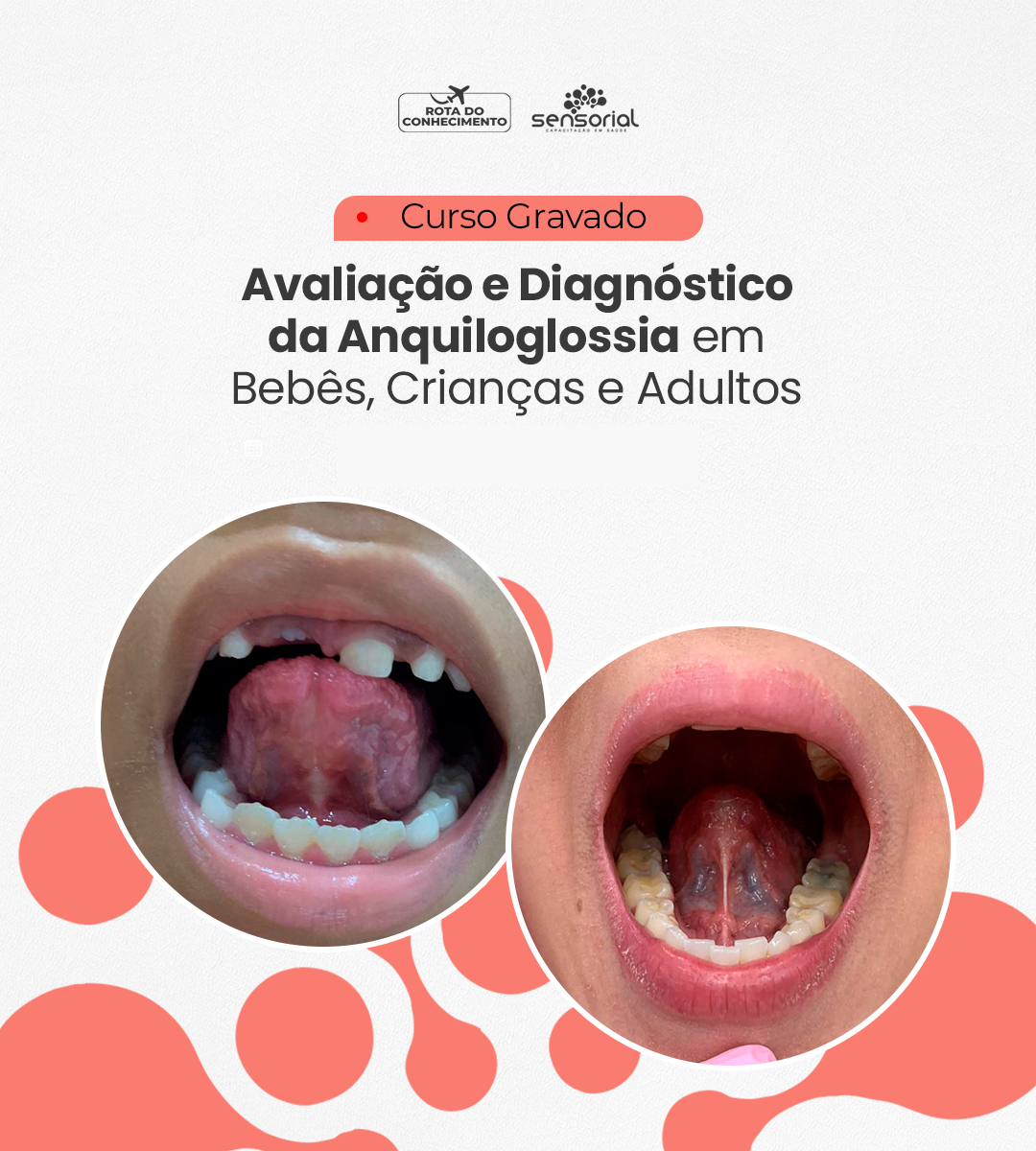 Anquiloglossia.jpg
